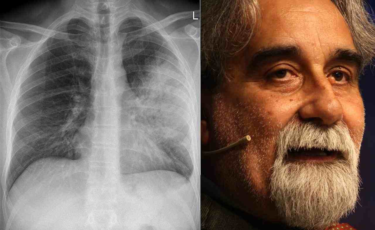 Polmonite interstiziale, la verità sulla malattia che ha ucciso il maestro Vessicchio | Questi sono i sintomi fantasma da non sottovalutare